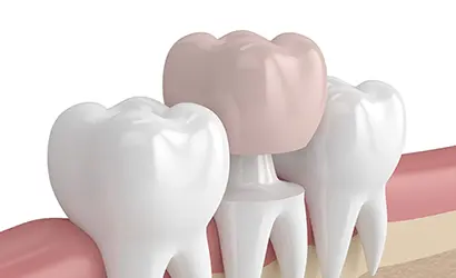 Fogpótlás – amikor a hiányzó fogak újra teljessé tehetők