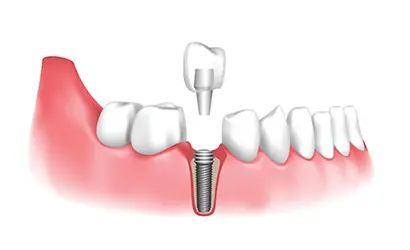 Fogpótlás Budaörsön 