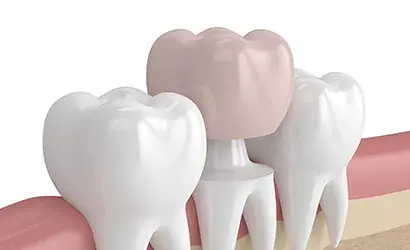 Fogpótlás – amikor a hiányzó fogak újra teljessé tehetők