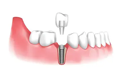 Fogpótlás Budaörsön 