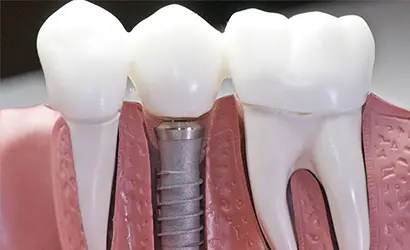Implantációs fogpótlás – Tartós megoldás hiányzó fogak pótlására