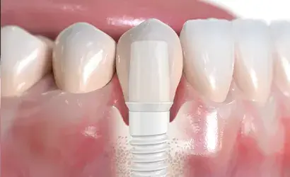 Az implantátum beültetés menete: hogyan jut el a konzultációtól a végleges fogpótlásig?