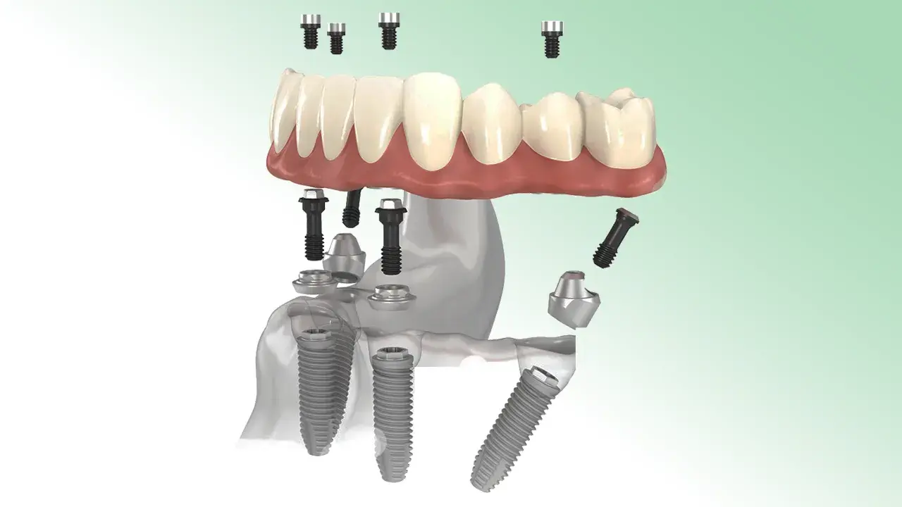 MI AZ ALL-ON-4 RENDSZER?