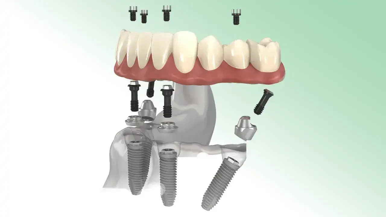 ALL-ON-4 FOGPÓTLÁS