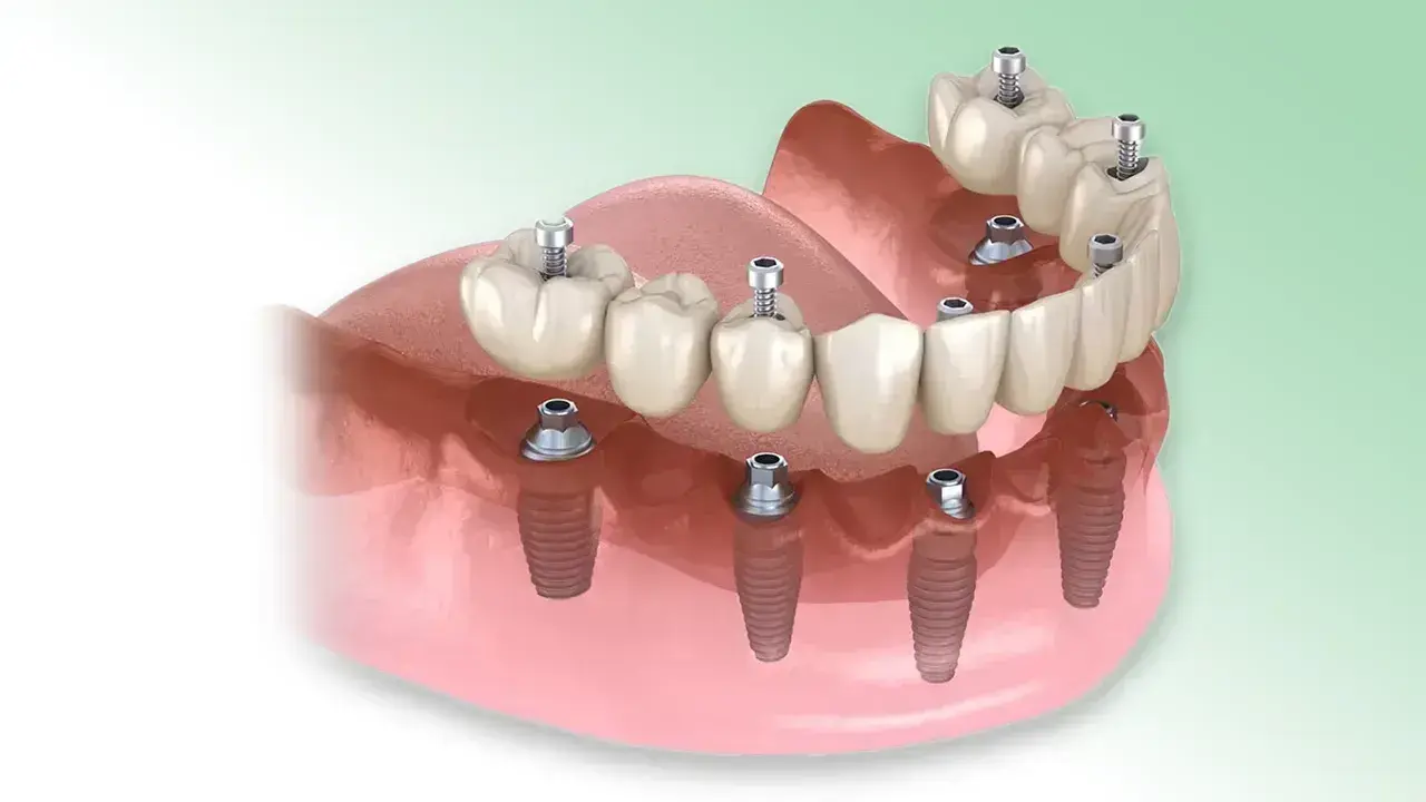 ALL-ON-6 FOGPÓTLÁS