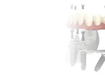 All-on-4 fogpótlás