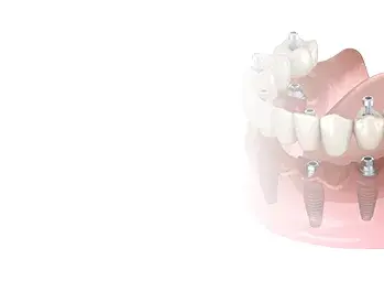 All-on-6 fogpótlás