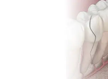 Betört fog eltávolítása