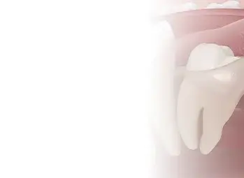 Bölcsességfog eltávolítása